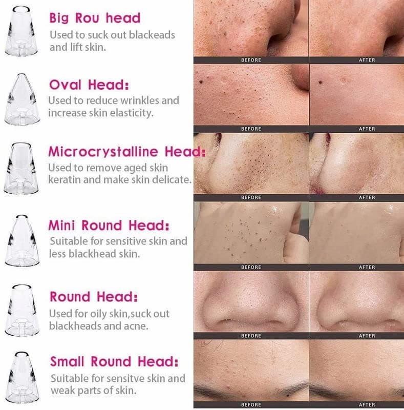 ⭐ DermaGlow 5-in-1 Blackhead Vacuum Pore Cleaner